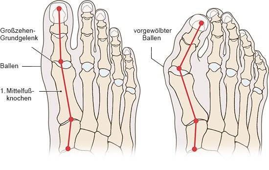 Hallux valgus – Ursachen, Diagnostik und moderne Therapie